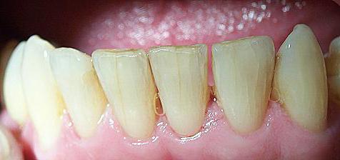 трещины на зубах 
