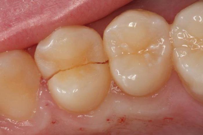 трещина на зубе переднем