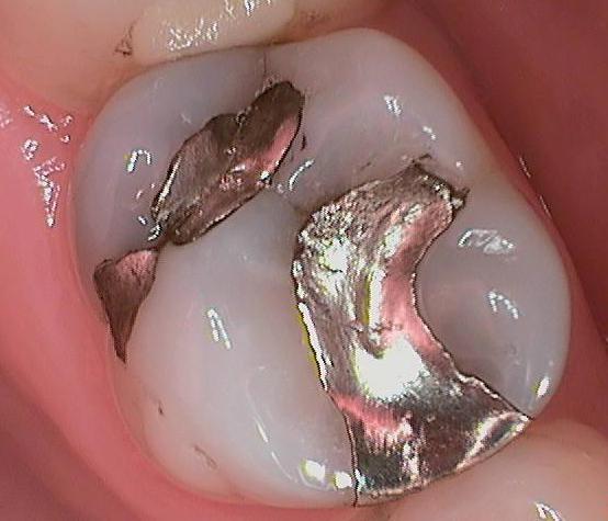 трещина в корне зуба