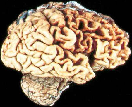 Признаки атрофии мозга. Дегенерация головного мозга.