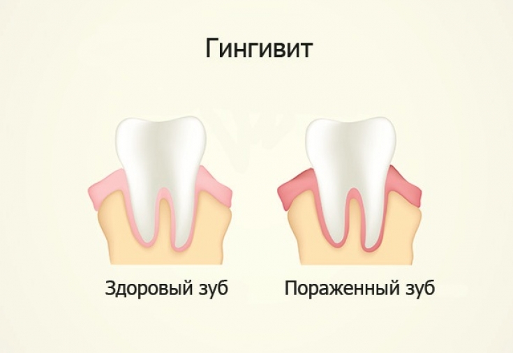 Как выглядит воспаленная десна фото