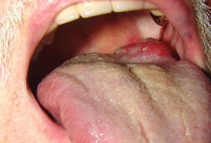 стадии рака языка 
