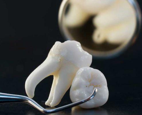 больно ли удалять корни разрушенного зуба