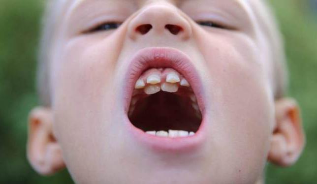 сверхкомплектный зуб у ребенка