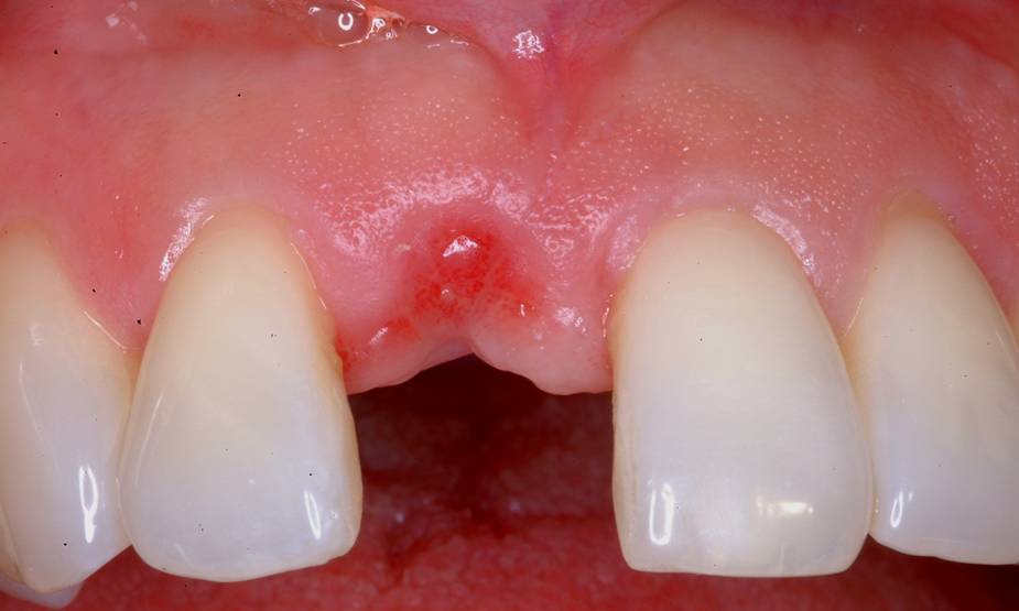 удаление переднего нижнего зуба