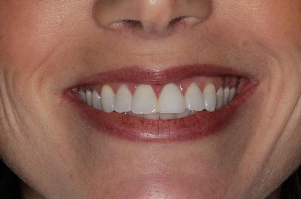 удаление передних молочных зубов