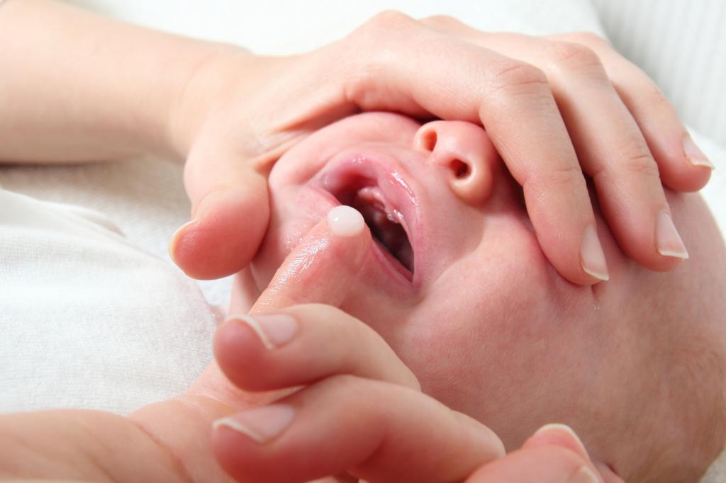Как чистить язык новорожденному от молочницы