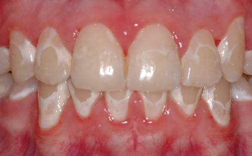 начальный кариес зубного ряда