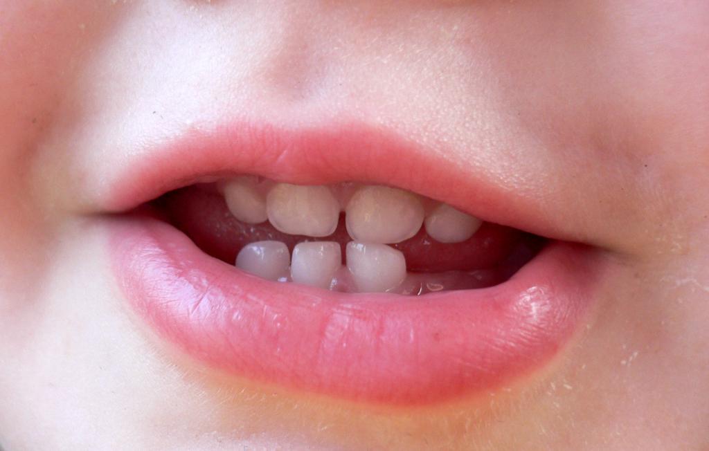 кариес на зубках ребенка