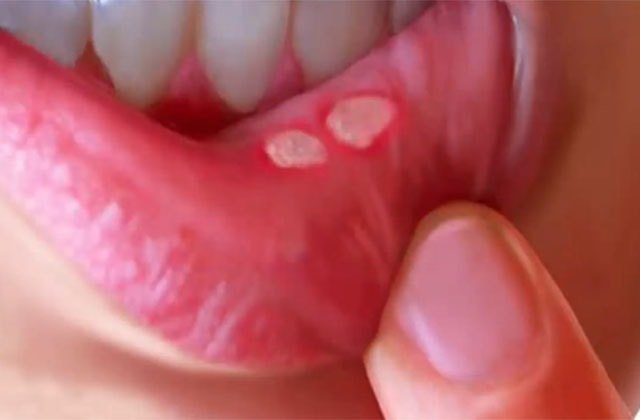 афтозная язва во рту лечение