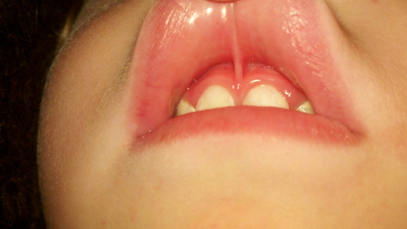 пластика уздечки верхней губы у ребенка
