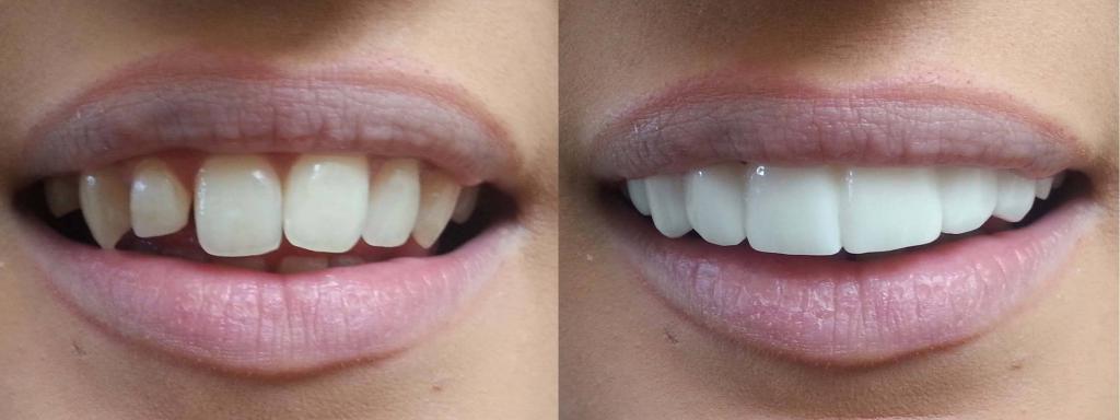 зубы до и после