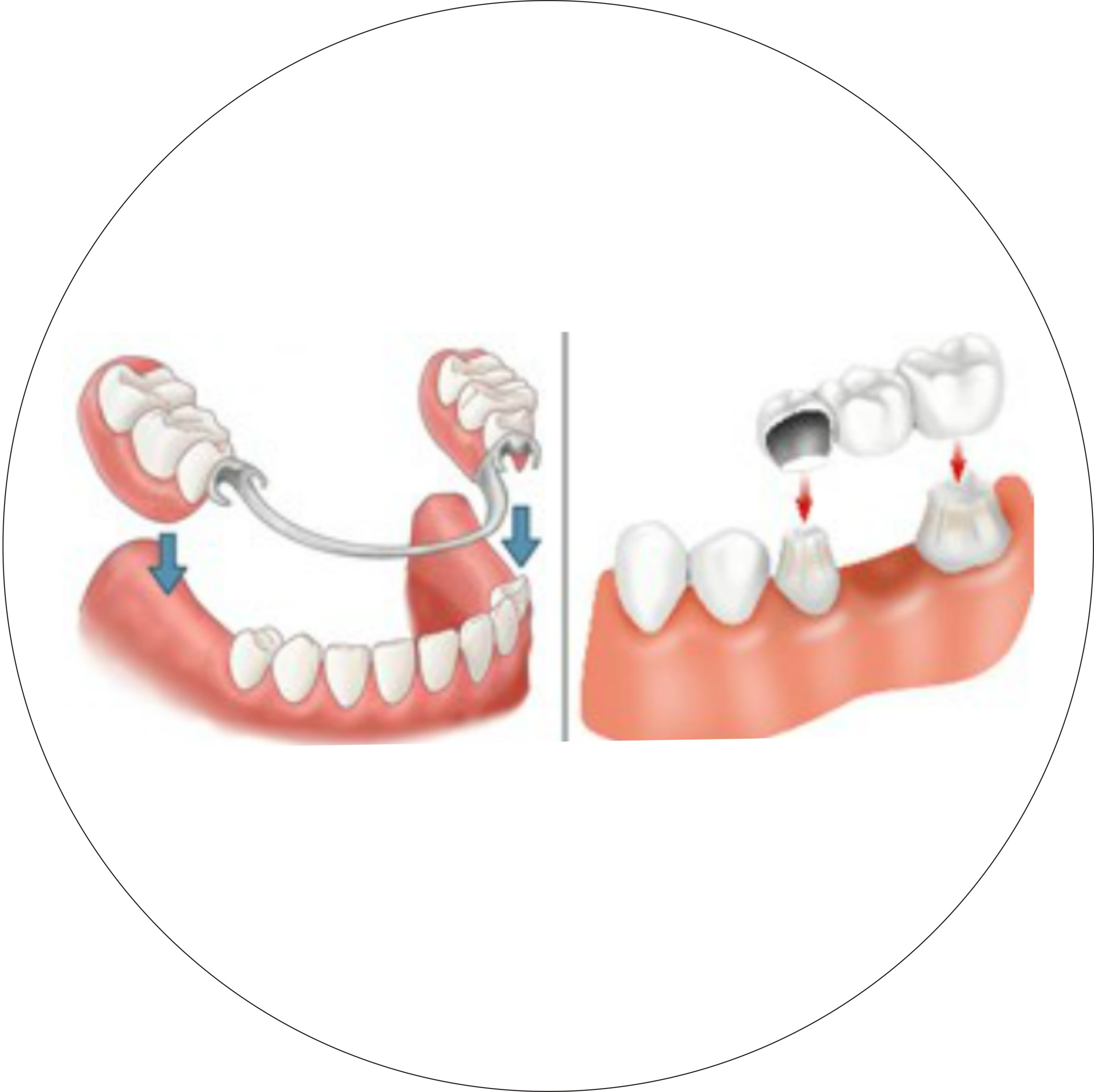 зубной мост 3 зуба