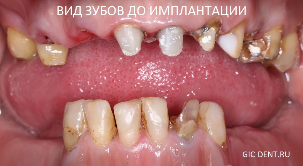Состояние зубов и десен до проведения имплантации и протезирования