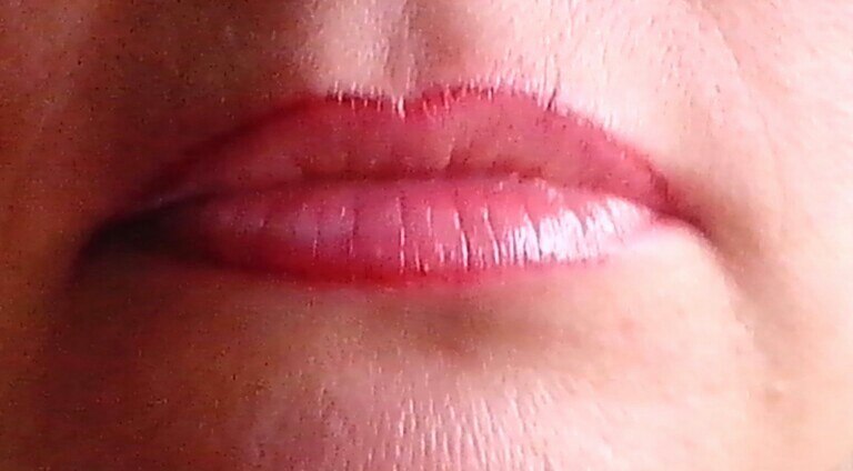 Верхний край губы. Воспаление каймы губ (хейлит). Эксфолиативный хейлит. Лимфоэдематозный хейлит.