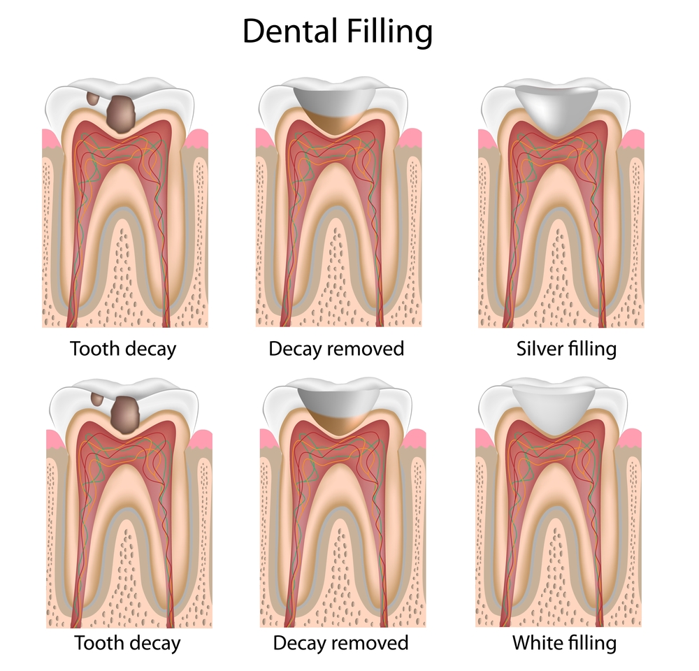 Illustration of tooth receiving a white dental filling
