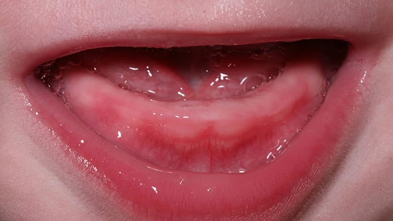 Припухлость и отечность десен - признаки прорезывания зубов у детей.
