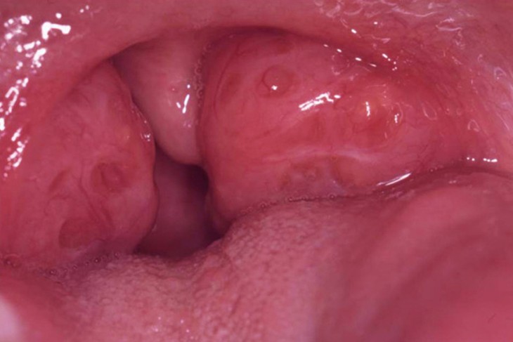 enlarged tonsils pictures 2