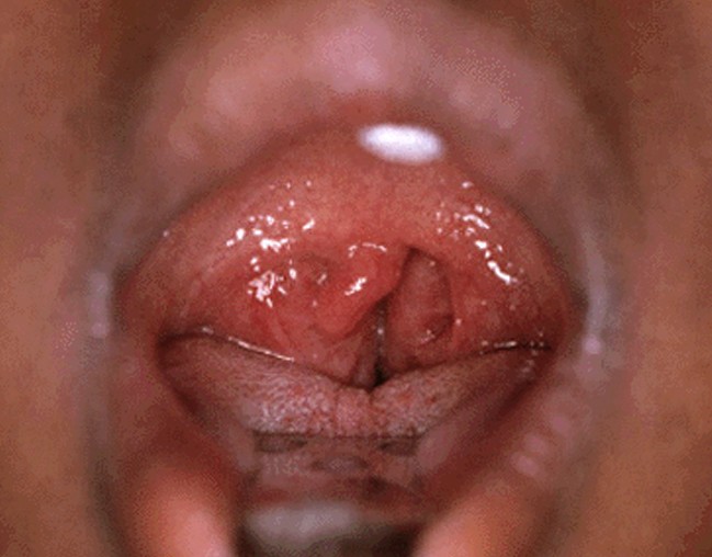 enlarged tonsils pictures 3