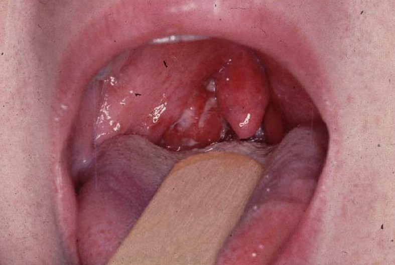 enlarged tonsils pictures 4