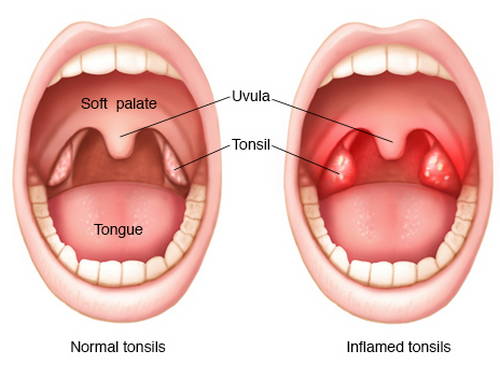 A comparison image between normal tonsils and inflamed tonsils Holes in tonsils image photo picture