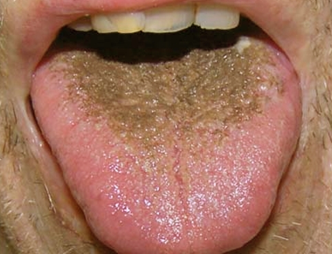 brown spots on tongue