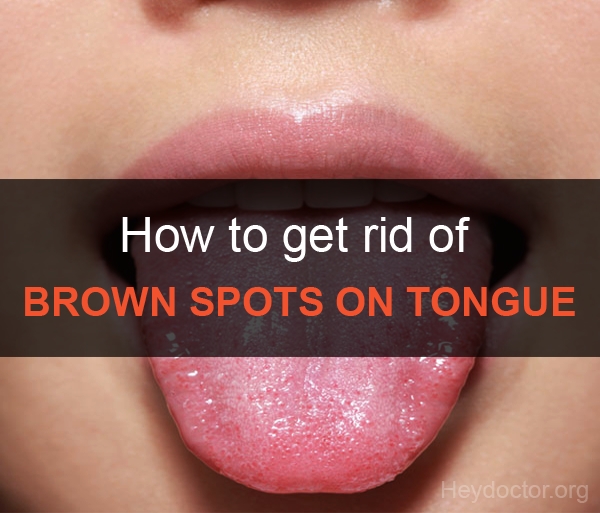 how to get rid of brown spots on tongue