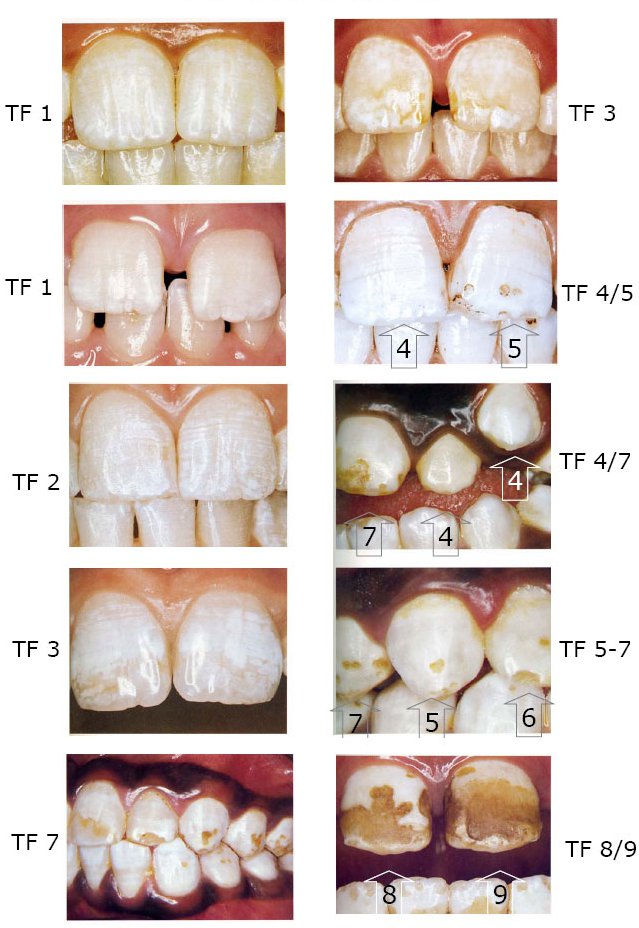 Фото флюорозных зубов (классификация по Тилструпу- Фейерскову)