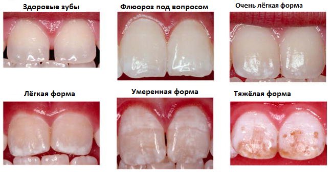 Формы флюороза по Дину (фото флюорозных зубов)
