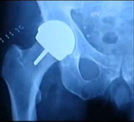 Risk: Metal hip replacements by DePuy have already been recalled by hospitals for tests