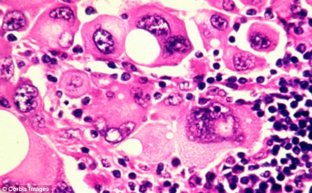 Unlike most cases of melanoma of the skin, oral malignant melanoma is not considered to be related to or affected by UV exposure, smoking, drinking or poor oral hygiene. (Human melanoma cells are pictured)