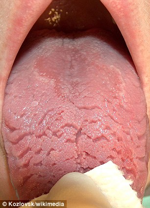 Researchers in Israel claim that geographic tongue (GT) changes the tongue