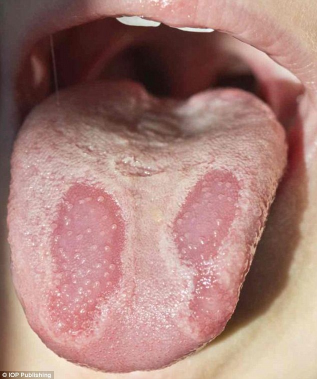 Researchers in Israel claim that geographic tongue (GT) changes the tongue