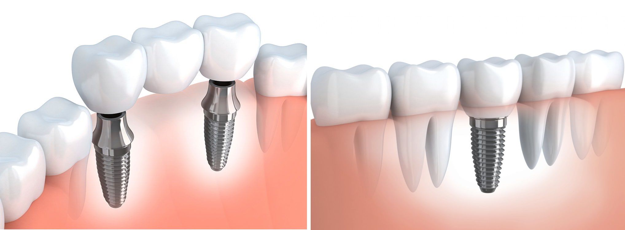 Какой имплант зуба лучше