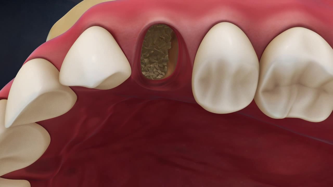 Зуб без кости. Наращивание костной ткани. Имплантация кости для зуба. Костная ткань в стоматологии.