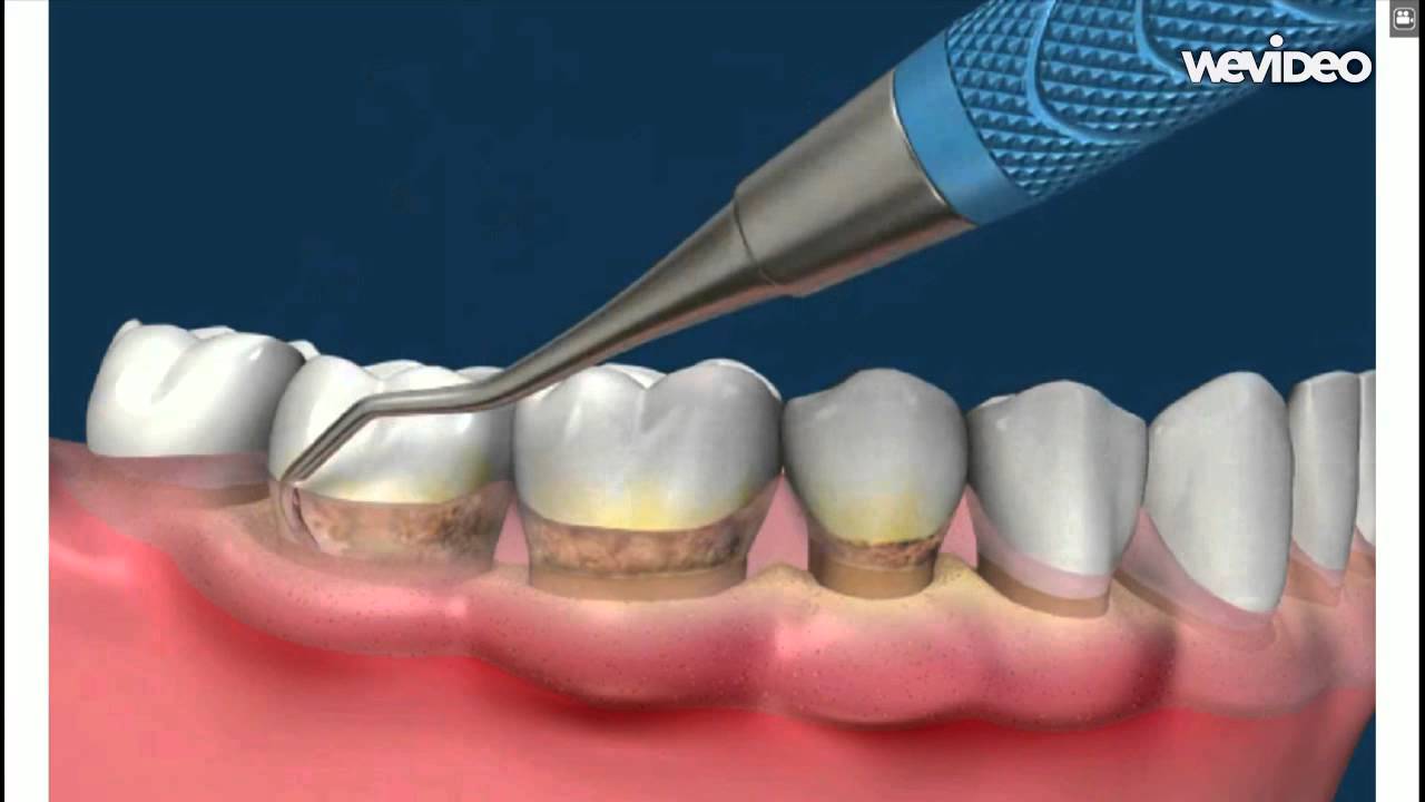Удаление зубного камня. Зубной камень и пародонтоз. Пародонтоз стоматология. Пародонтит зубной камень. Воспаление десен от зубного камня.