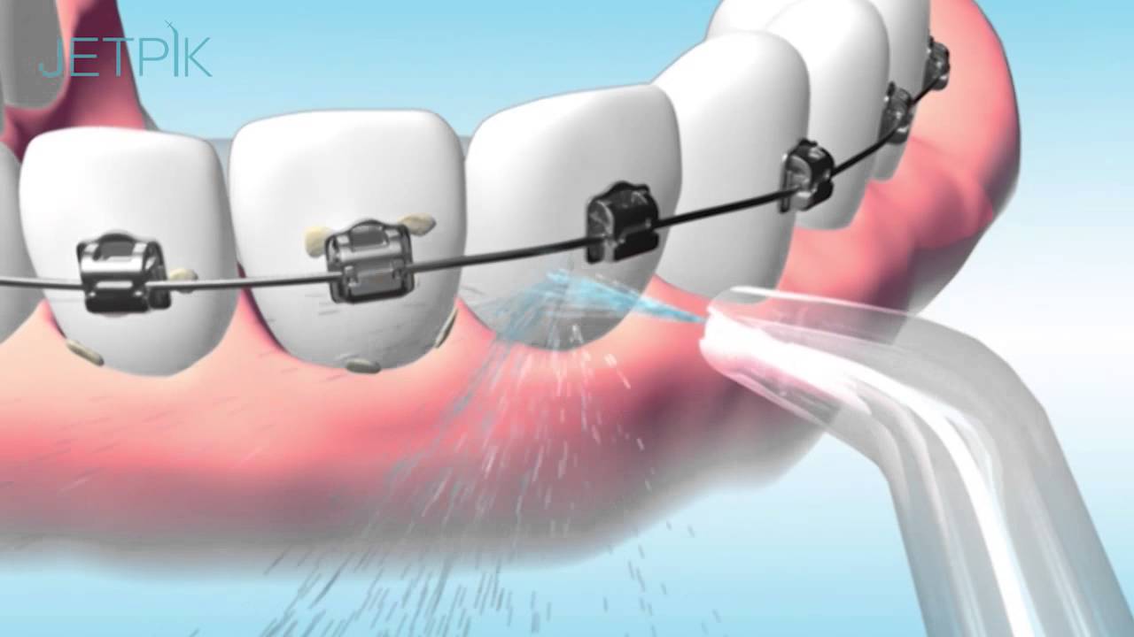 Ирригатор для брекетов. Ирригатор для полости рта брекеты. Брекет система ирригатор. Ирригатор для коронок и брекетов.