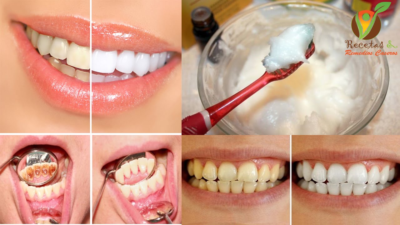 Blanquear dientes con bicarbonato
