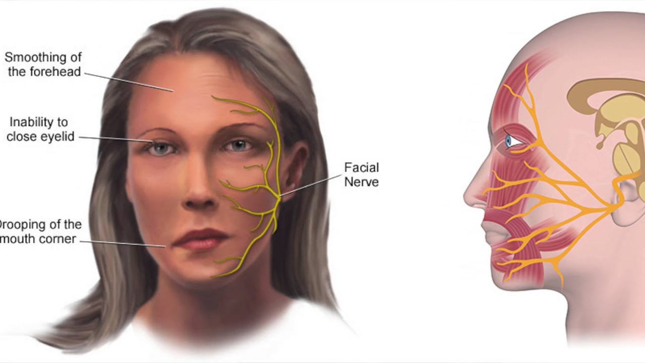 Лицевой нерв фото. Воспаленный лицевой нерв. Воспаление тройничного лицевого нерва.