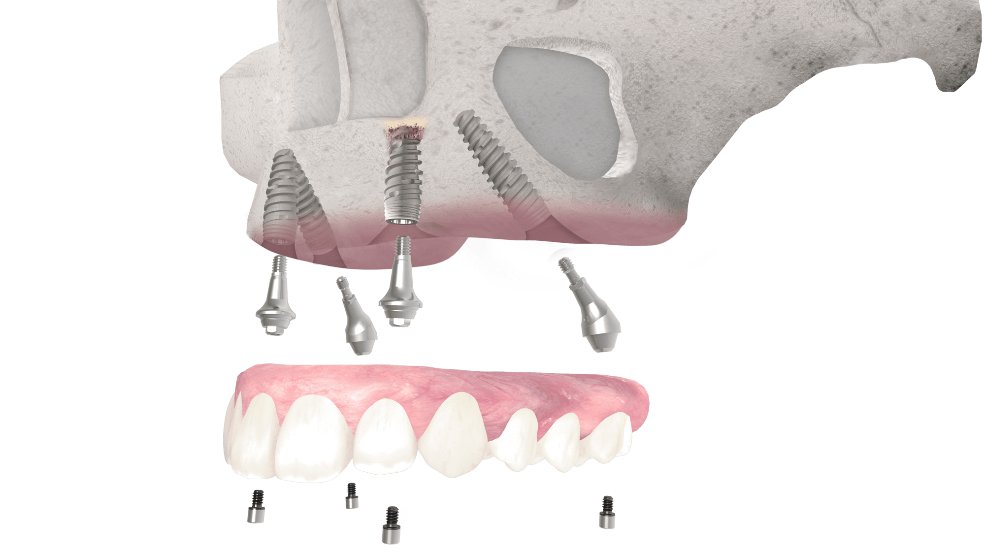 Имплантация sup aznona com. Имплантация всей челюсти all on 4. Имплантация зубов верхней челюсти.