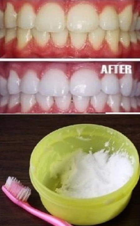 Эффективное отбеливание в домашних условиях. Эмаль для отбеливания зубов. Отбеливание зубов в стоматологии до и после. Лазерное отбеливание зубов до и после. Как отбелить зубы в домашних условиях.