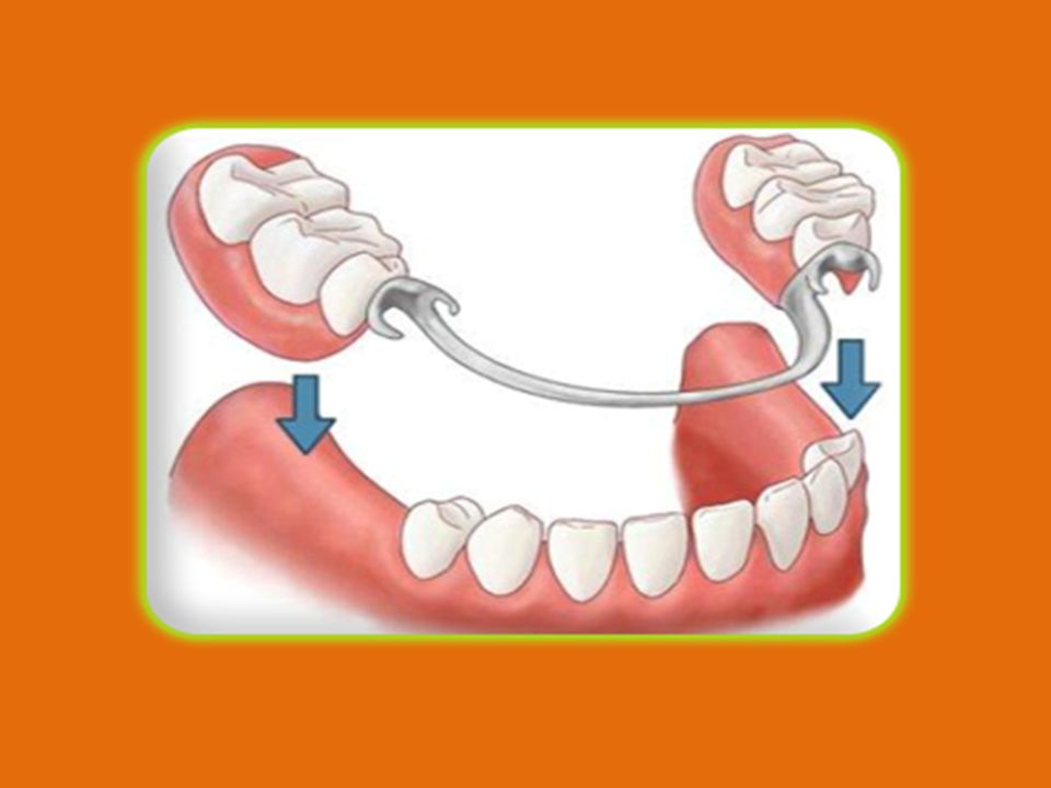 So what is it. Clasp denture is based like arc, and in contrast to other prosthesis, it uses for support not only gum, but also patient’s teeth. Thanks to it, bugle is more sensitive to gum, also there is considered, that clasp prosthesis can supply masticatory load more naturally. Thereby clasp denture wins traditional laminar removable dental prosthesis. In addition, we can to add that clasp denture looks compact, is comfortable in using and long-lived. In dentistry is used clasp denture with telescopic fixation system and bugles with micro-locked fastening (clasp denture with klammers and locks).. Last few years, the clasp prosthesis, or also sometimes it is called bugle, is in the lead position (among removable prosthesis).