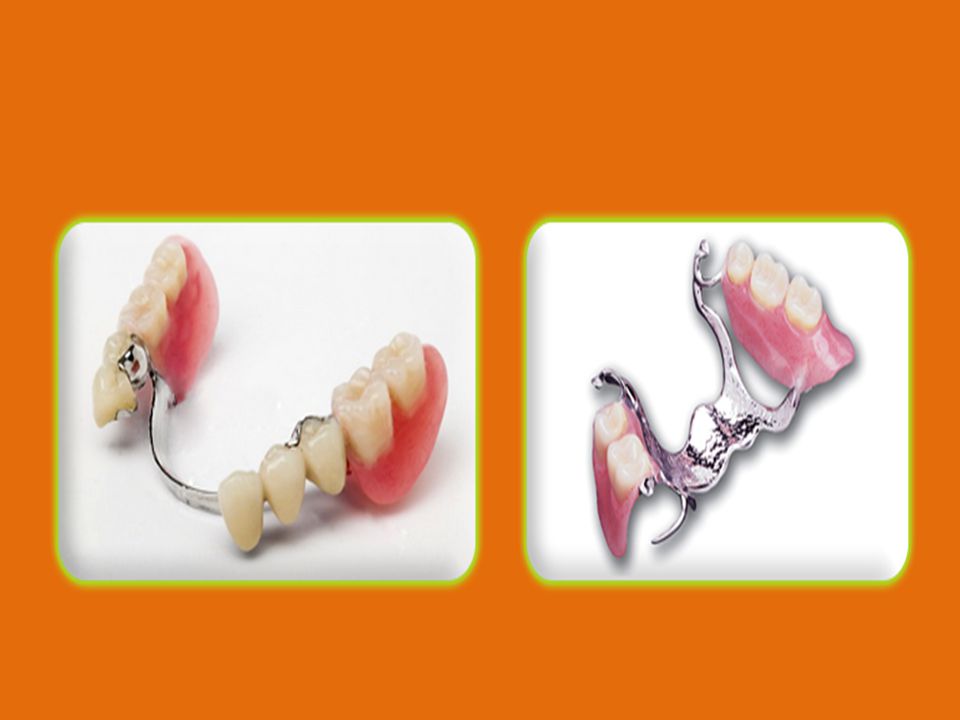 The second way of clasp fixation is with help of locks, which are fixed on abutment teeth, it’s more durable. The most important in lock fastening is its invisible, and that it is hided in clasp denture. Everything is supplied by high modern technologies – high-precision casting and special materials, and of course high skilled specialists. Clearly, that there is most desirable is last variant, though you have pay more, as the making process of clasp denture is hard and difficult! Clasp prosthesis with klammers is made to teeth, that’s why is fixed the best way on it, and thanks to elastic, it doesn’t spoil enamel. The one minus is the metal details are visible during smile.