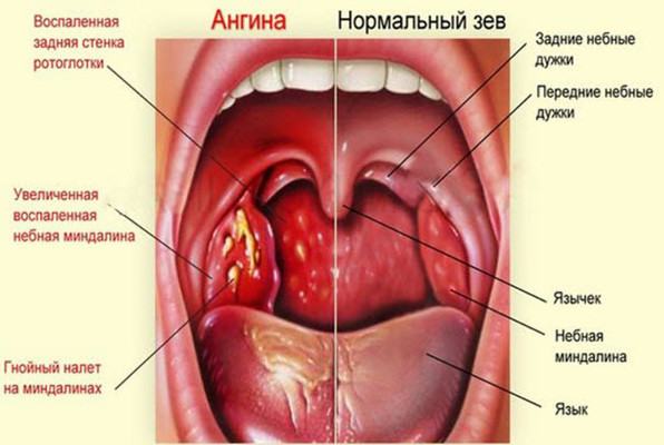 Симптомы ангины