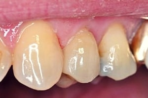 dental ceramics crown