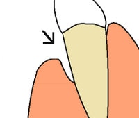 loss of gingival attachment