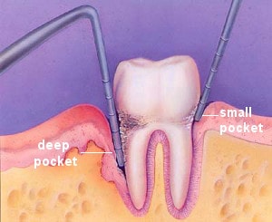 measuring the deepness of periodontal pockets with a periodontal probe