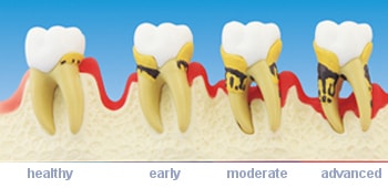 progression of periodontitis