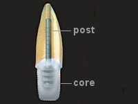 post and core structure