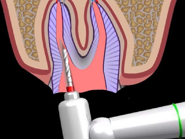 post and core procedure: root canal preparation